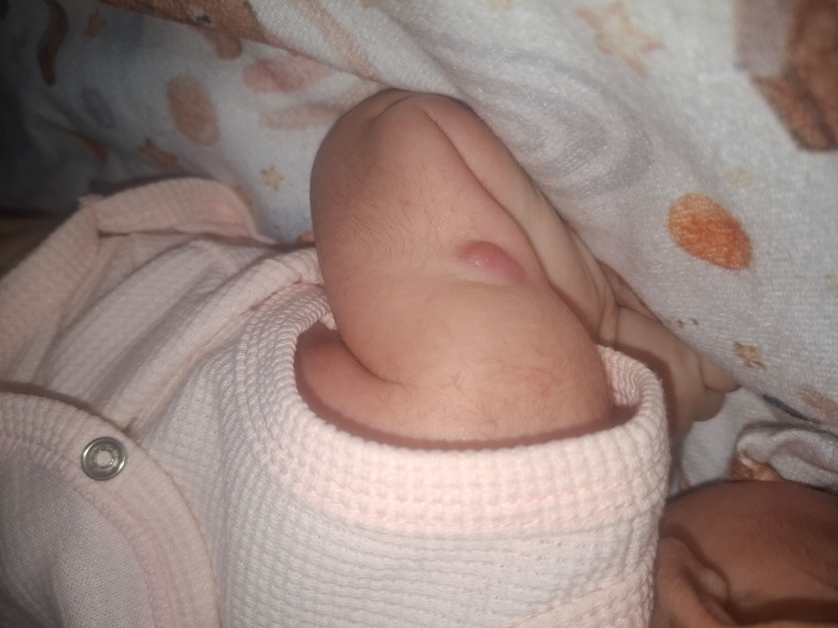 باد کردن جای واکسن