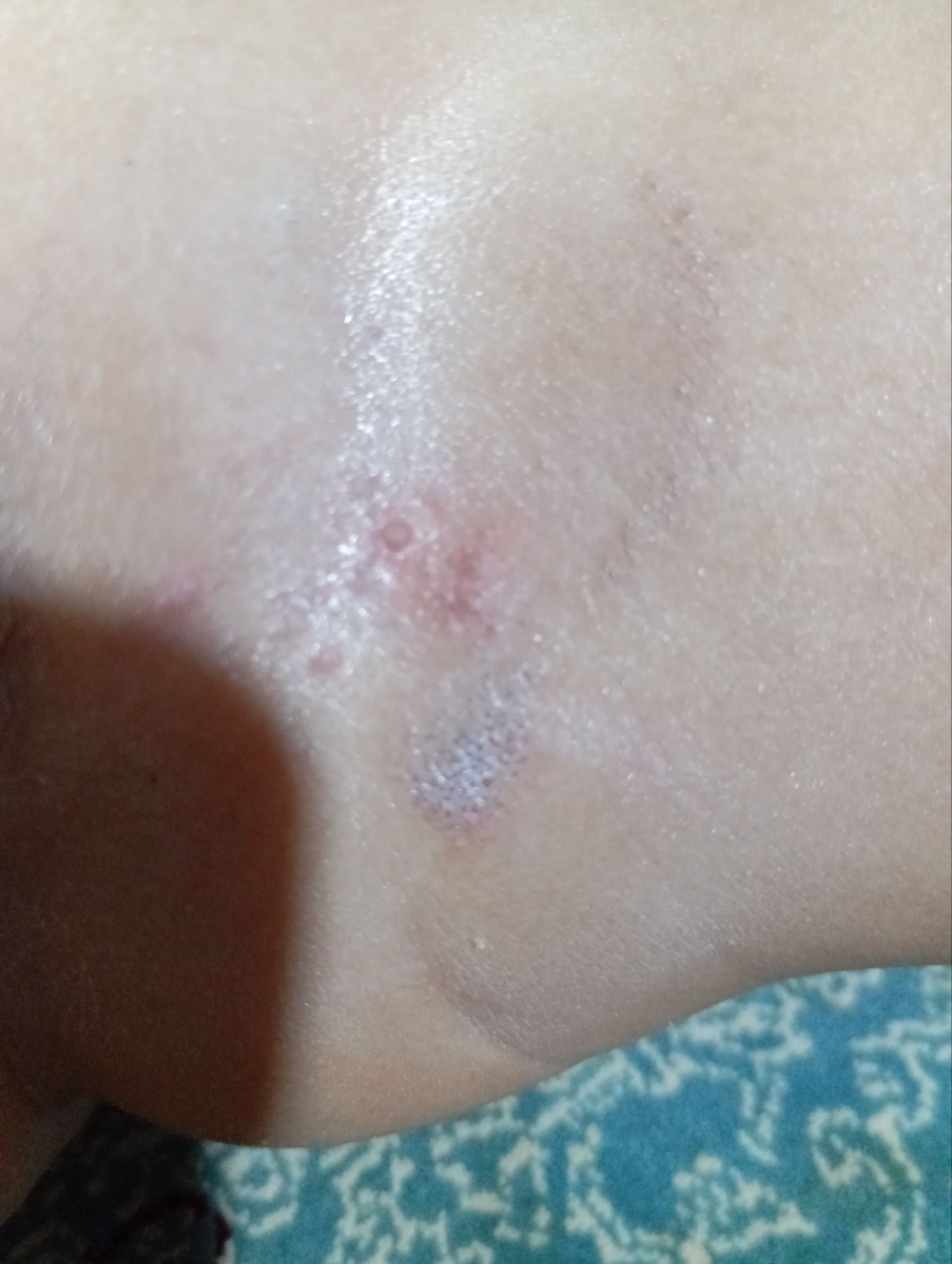 ادرار سوختگی کودک دوساله