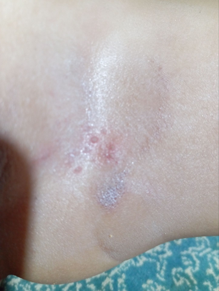 ادرار سوختگی کودک دوساله