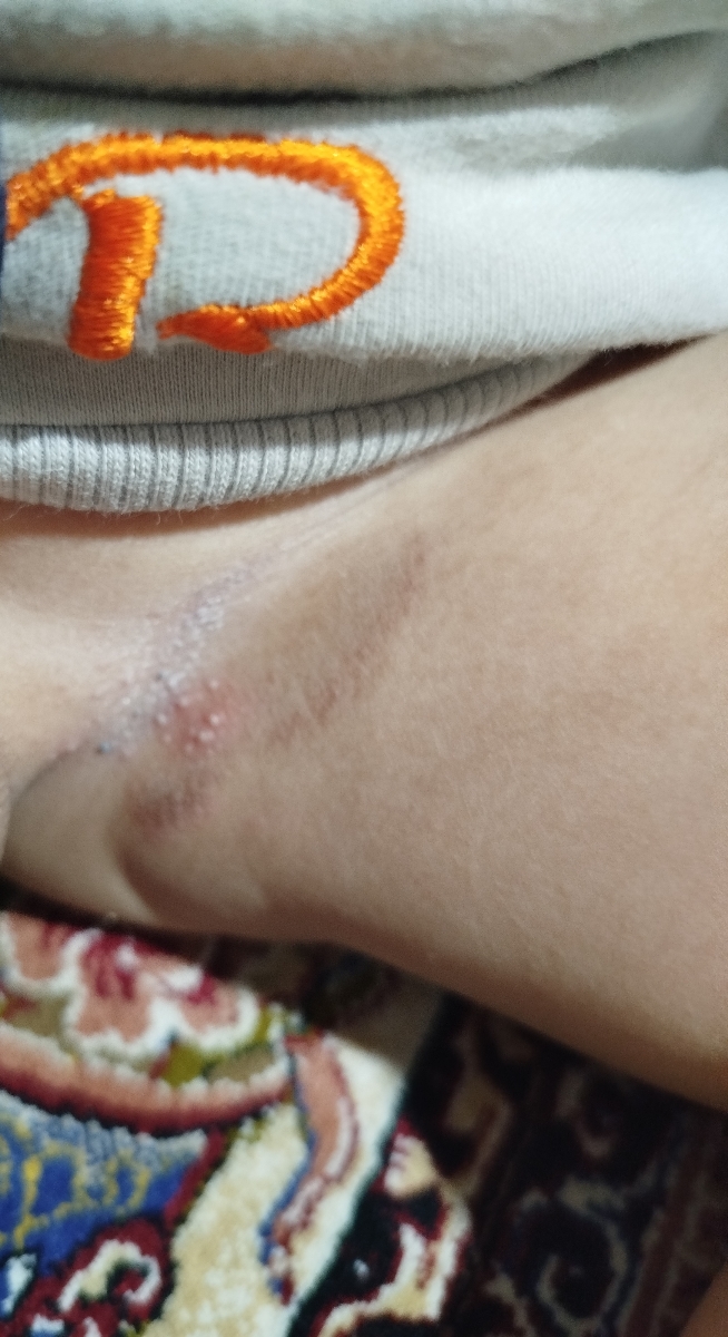 ادرار سوختگی کودک دوساله