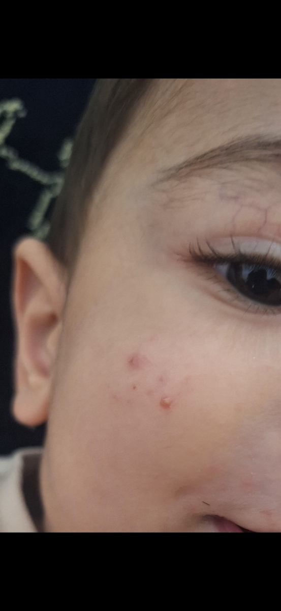 ماندن جوش روی صورت نوزاد