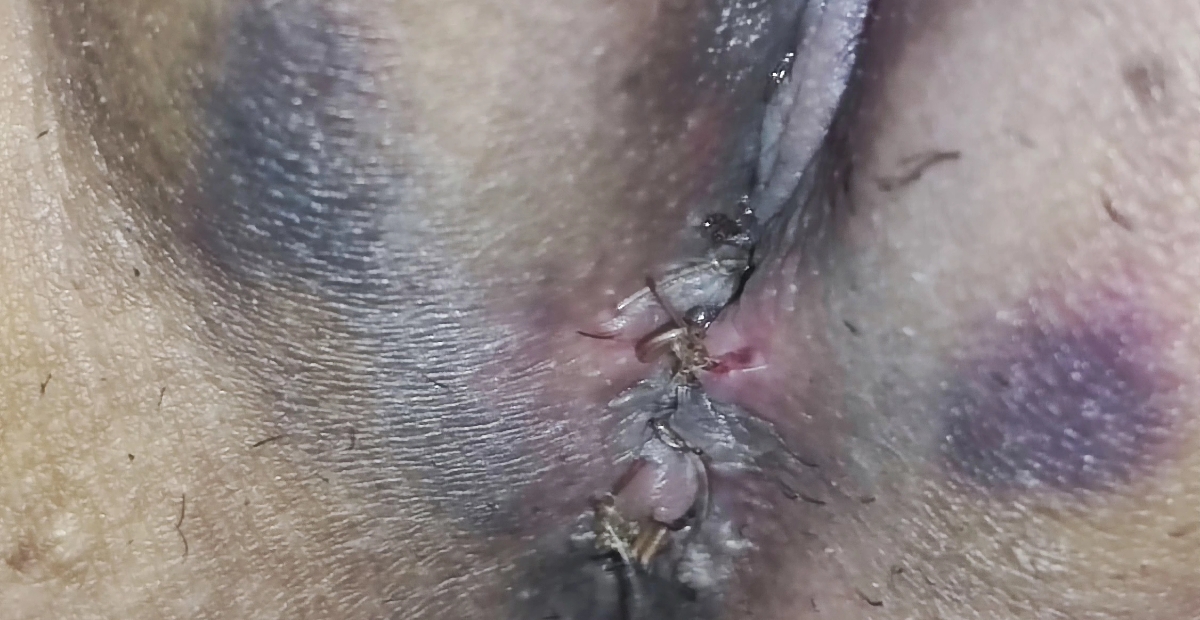 به نظر شما دکتر این حجم از کبودی طبیعی هست بعد تزریق چربی 