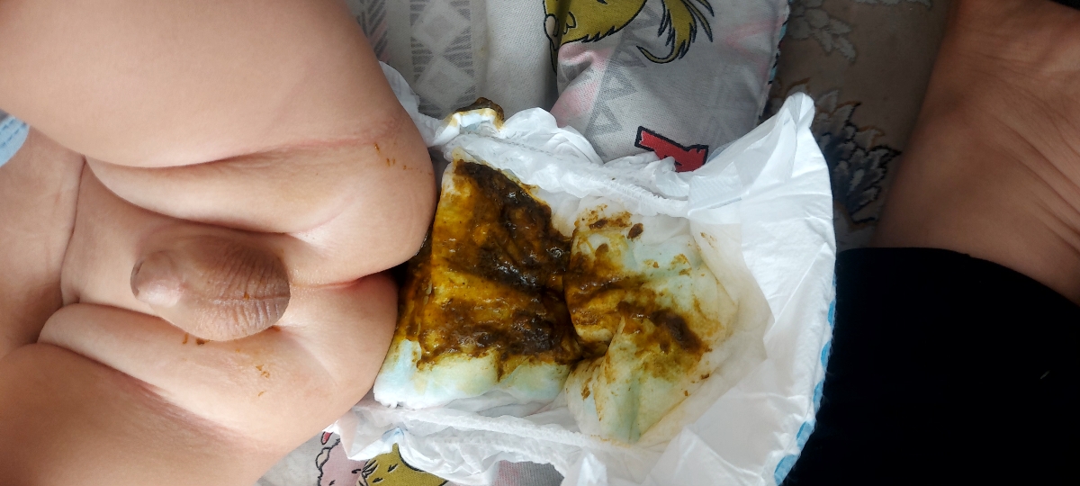 انفولانزا نوزاد ۷ ماهه