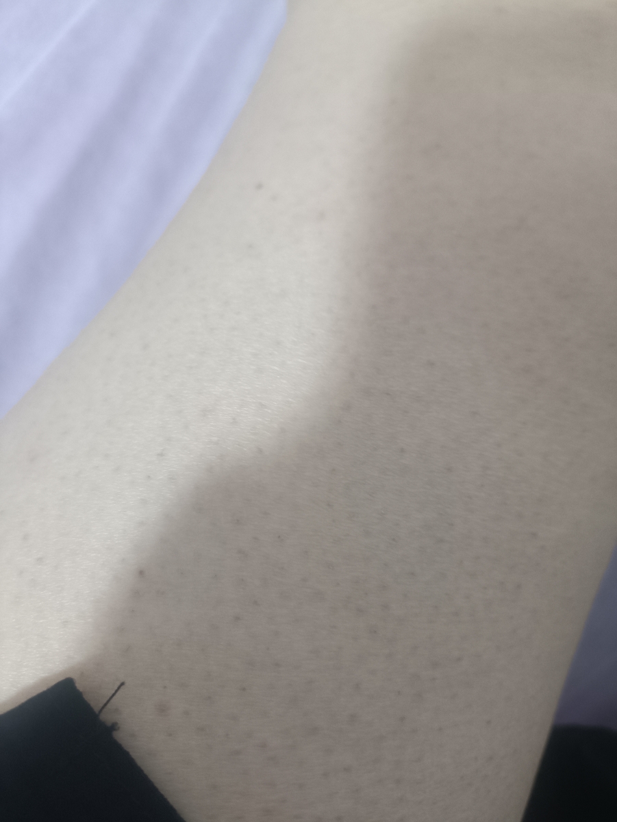 دون دون و پوست مرغی شدن پوست بعد از لیزر