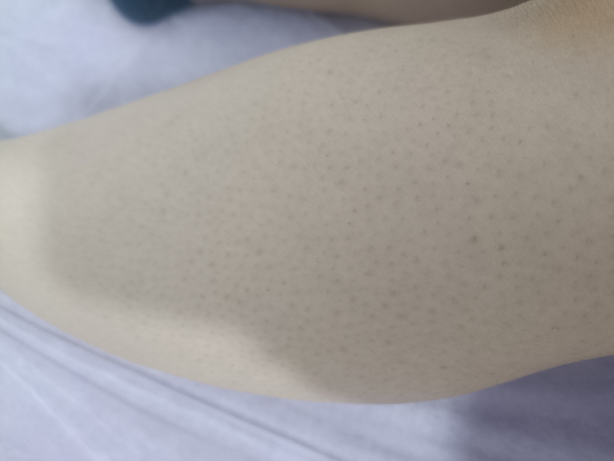 دون دون و پوست مرغی شدن پوست بعد از لیزر