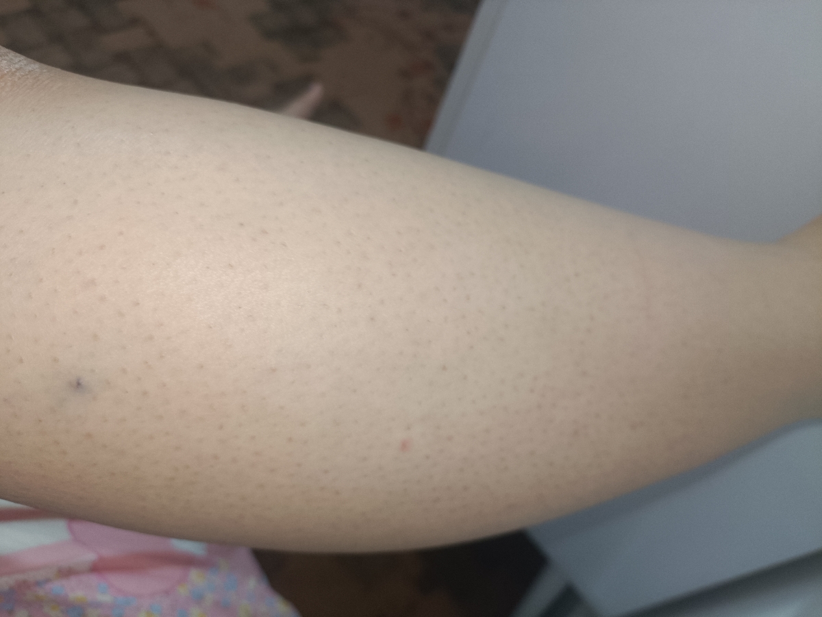 دون دون و پوست مرغی شدن پوست بعد از لیزر