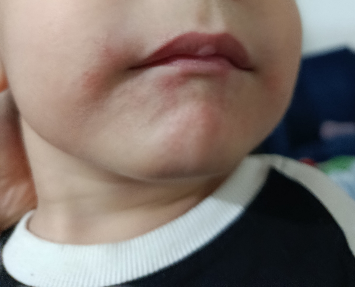 🌸 سلام دکترجان.شب همه ی ماماناام بخیر.عکس چونه ی پسرمو میذارم پایین⬇️