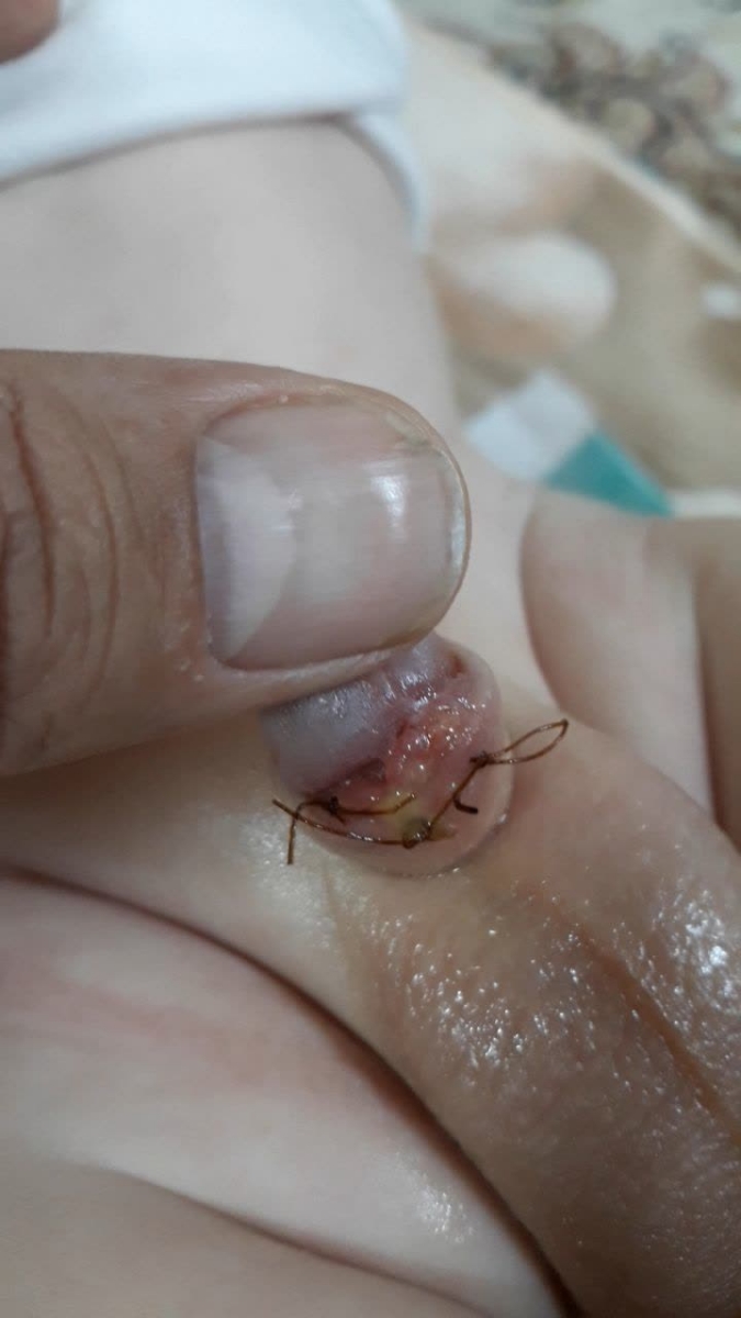 عکس محل ختنه بعد ده روز آیا عفونت کرده