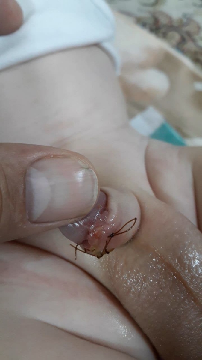 عکس محل ختنه بعد ده روز آیا عفونت کرده