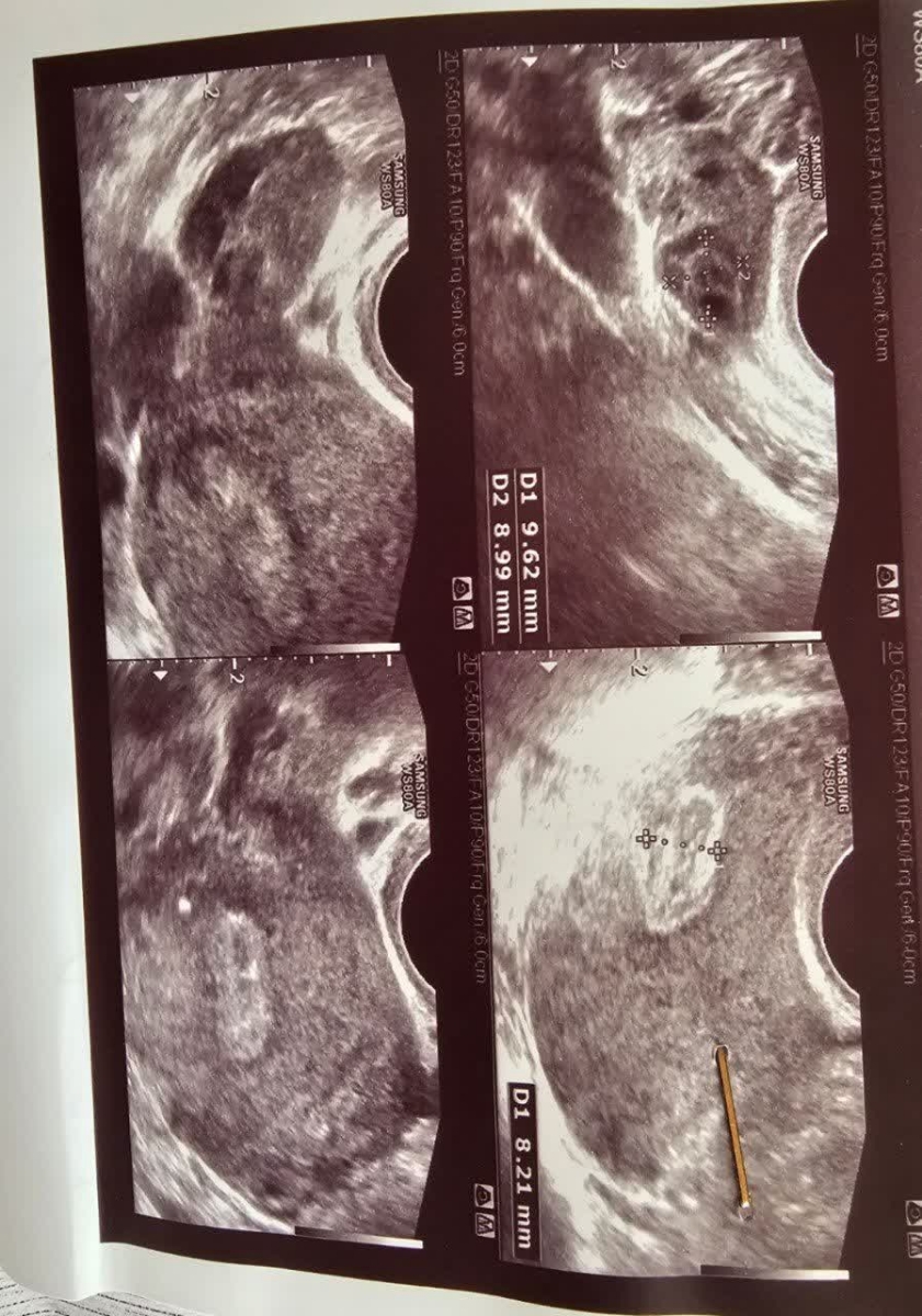 خانم دکتر سونو شکمی یا واژینال؟