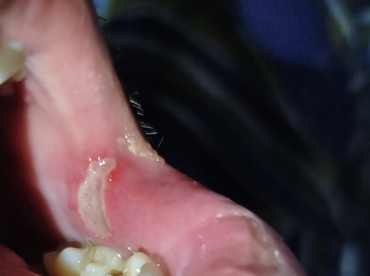 زخم دهان چرا خوب نمیشه