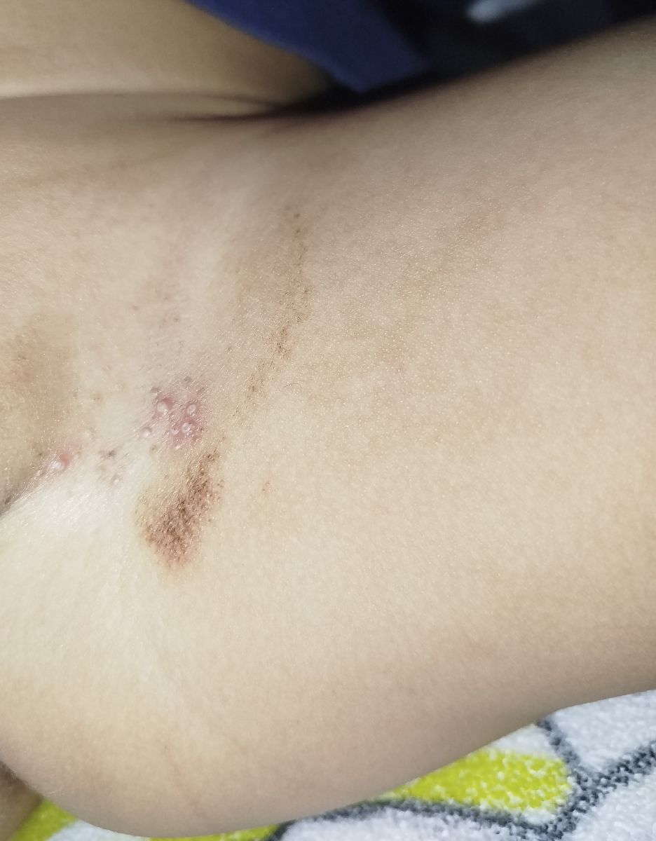 ادرار سوختگی کودک دوساله