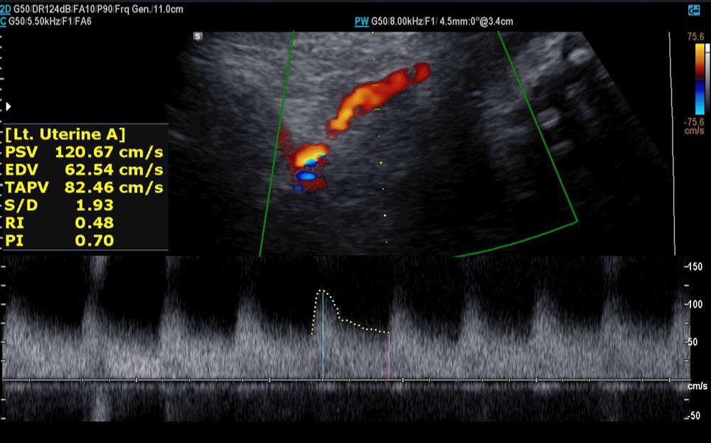 ✅️✅️✅️تفسیر سونو داپلر۳۶ هفته🙏🏻