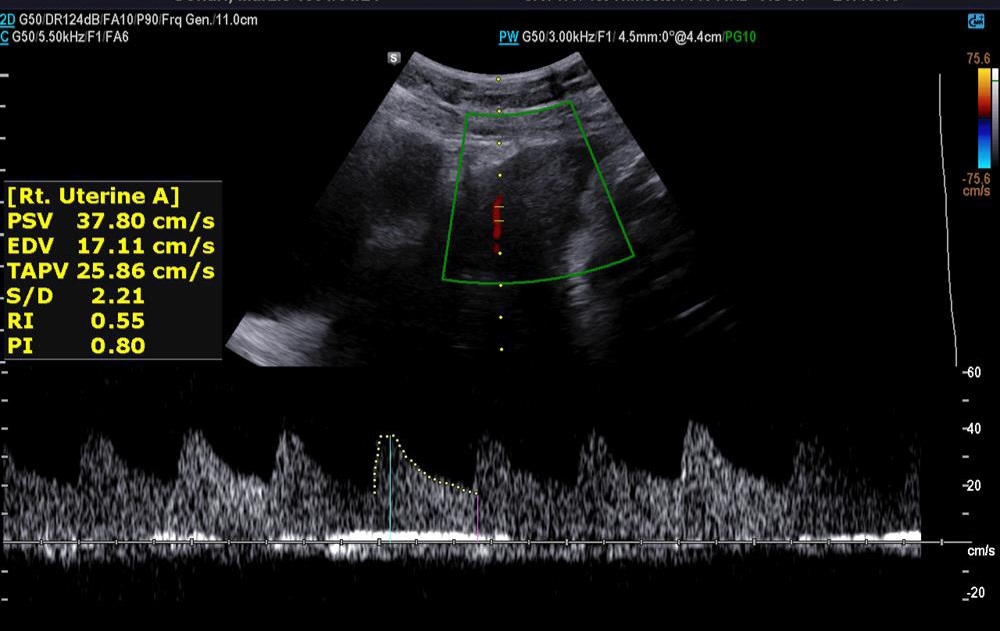 ✅️✅️✅️تفسیر سونو داپلر۳۶ هفته🙏🏻