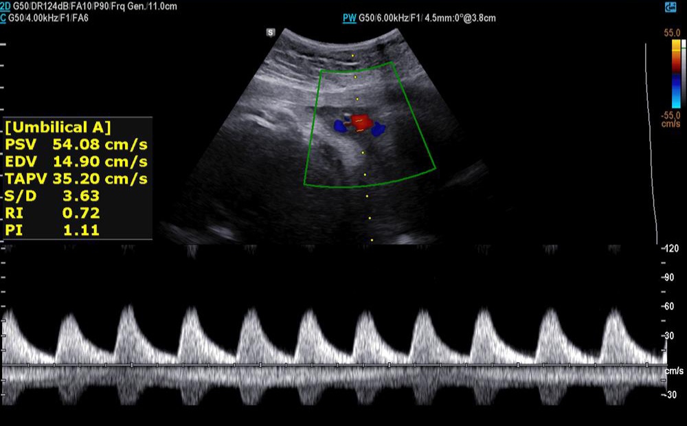 ✅️✅️✅️تفسیر سونو داپلر۳۶ هفته🙏🏻