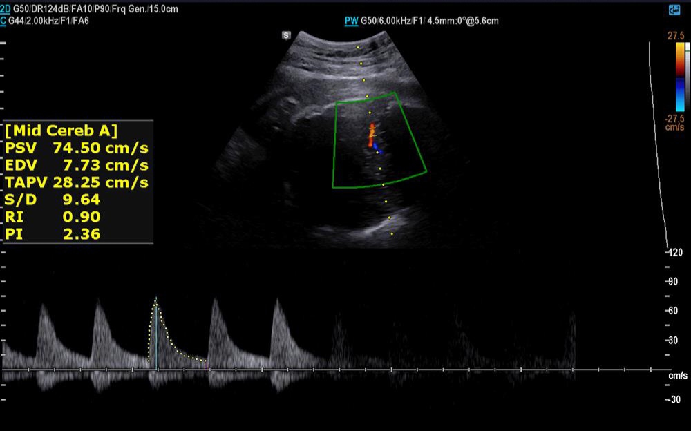 ✅️✅️✅️تفسیر سونو داپلر۳۶ هفته🙏🏻