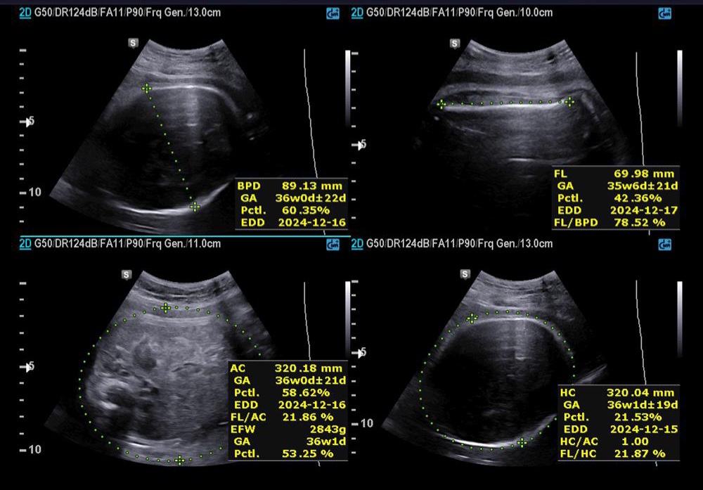 ✅️✅️✅️تفسیر سونو داپلر۳۶ هفته🙏🏻