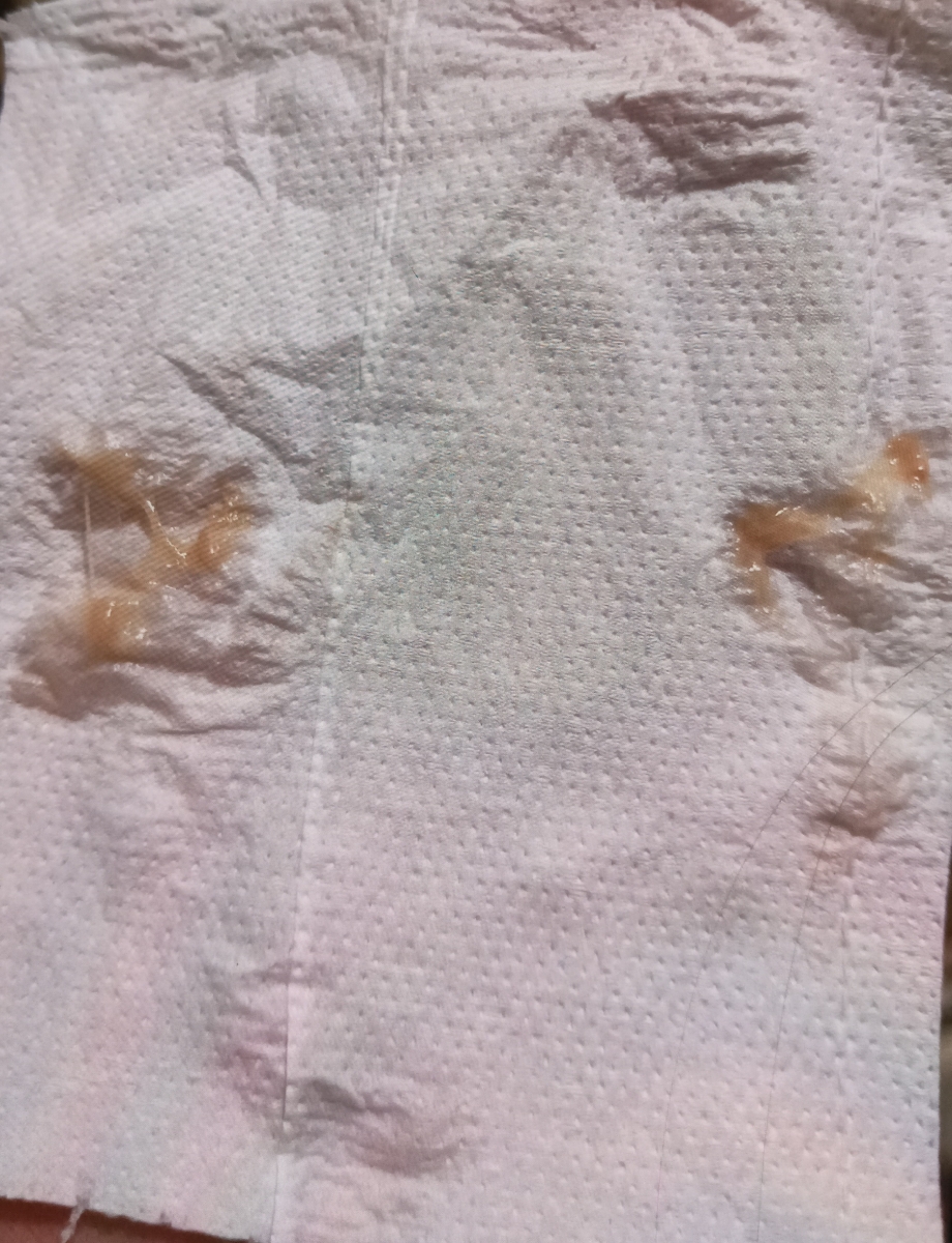 ترشح کرم زنگ در بارداری