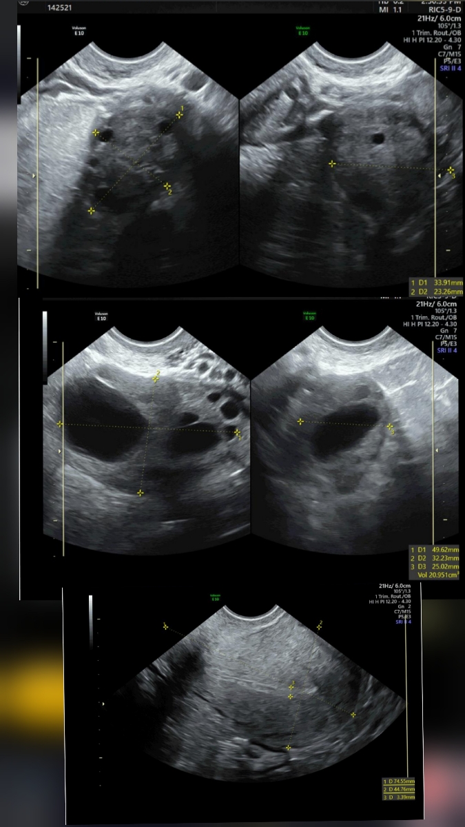کیست هموراژیک و کبد چرب
