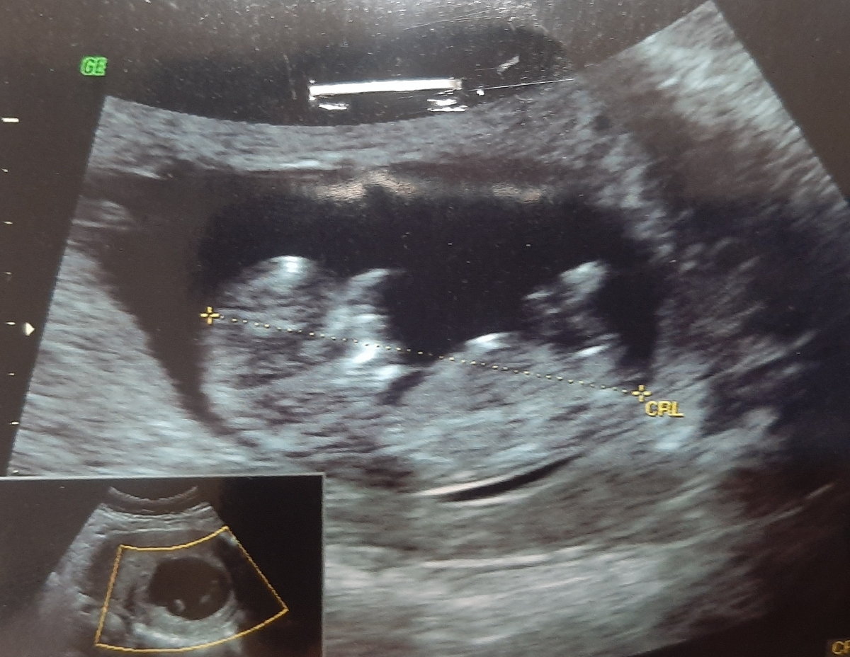 تفسیر عکس سونو