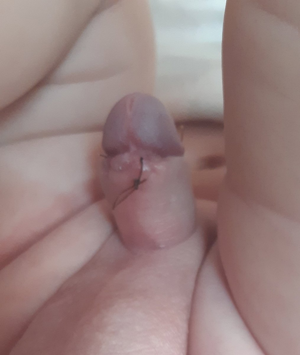 عکس محل ختنه بعد ده روز آیا عفونت کرده عکس محل ختنه بعد ده روز آیا عفونت کرده