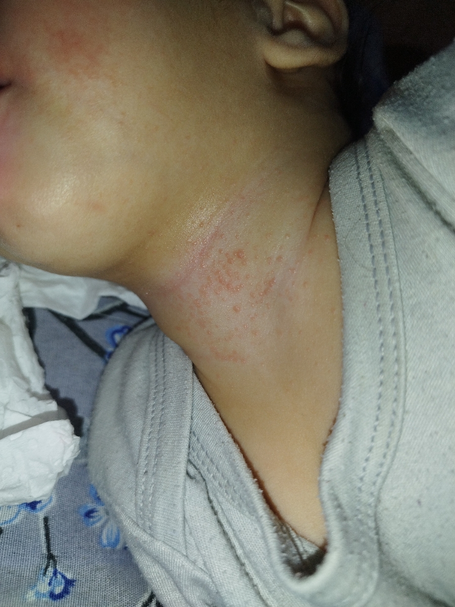 دانه های ریز گردن نوزاد ۵ماهه