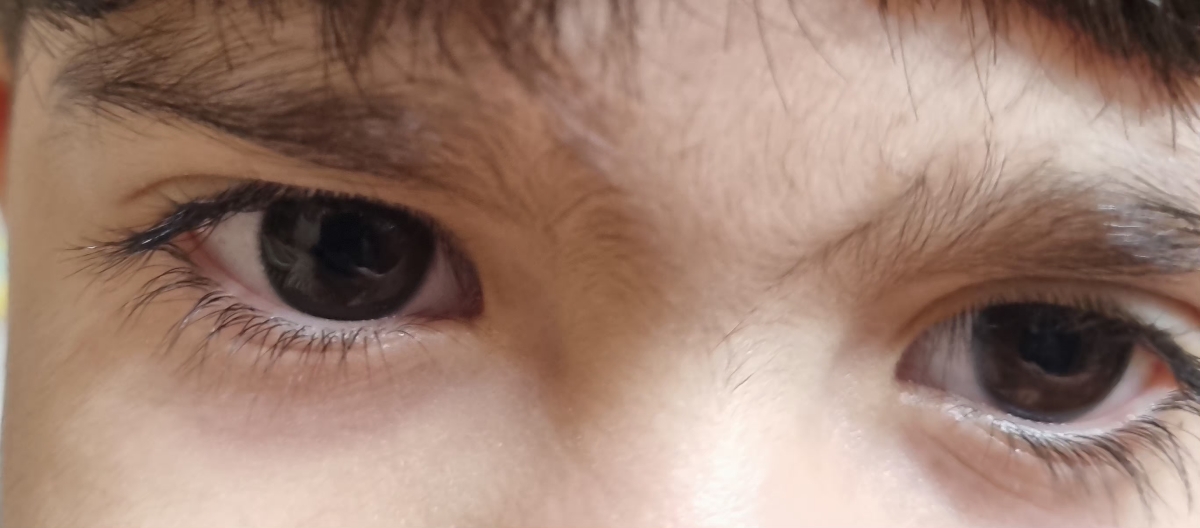 افتادگی یکی از پلک های پسرم