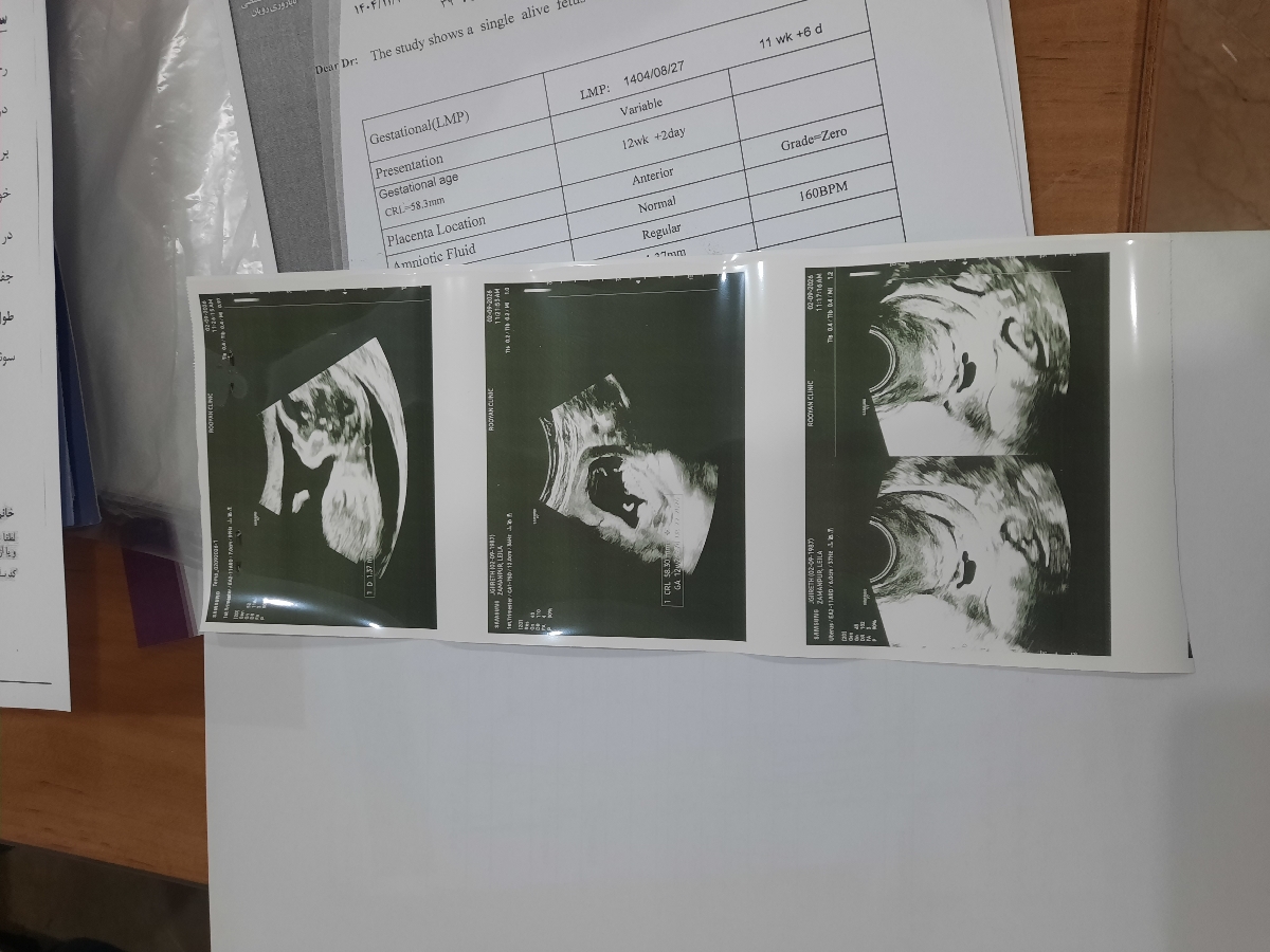 سونوگرافی NT وریسک غربالگری