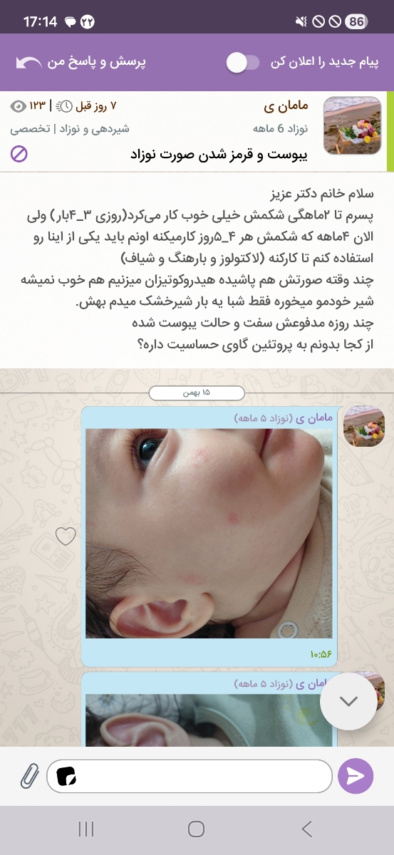 ازمایش مدفوع برای چک خون مخفی در مدفوع و کالپروتکتین