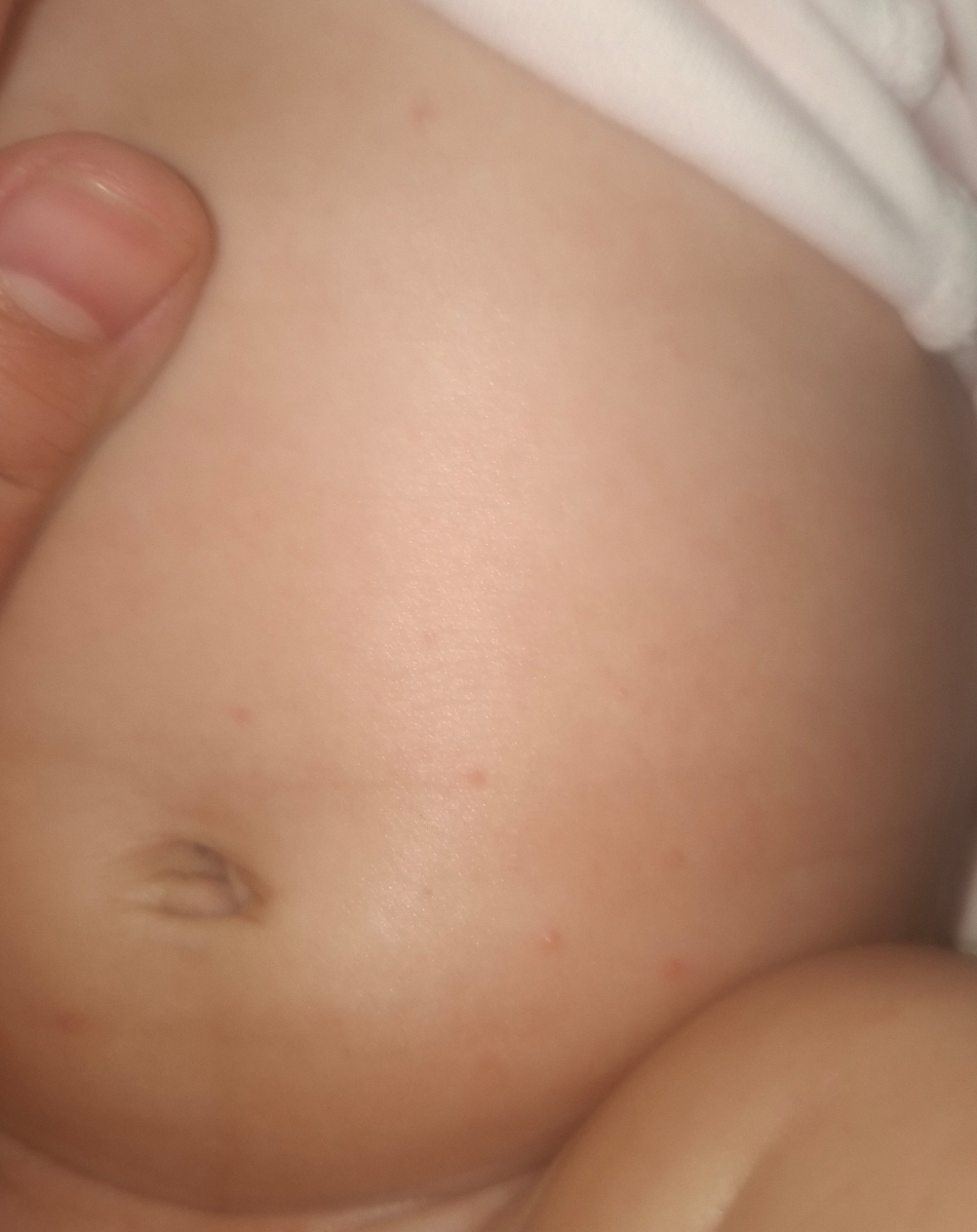 جوش زدن روی پوست نوزاد جوش زدن روی پوست نوزاد