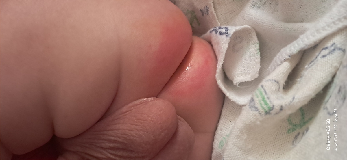 پسرم باز مقعدش سوخته،پمادهم میزنم خوب نمیشه