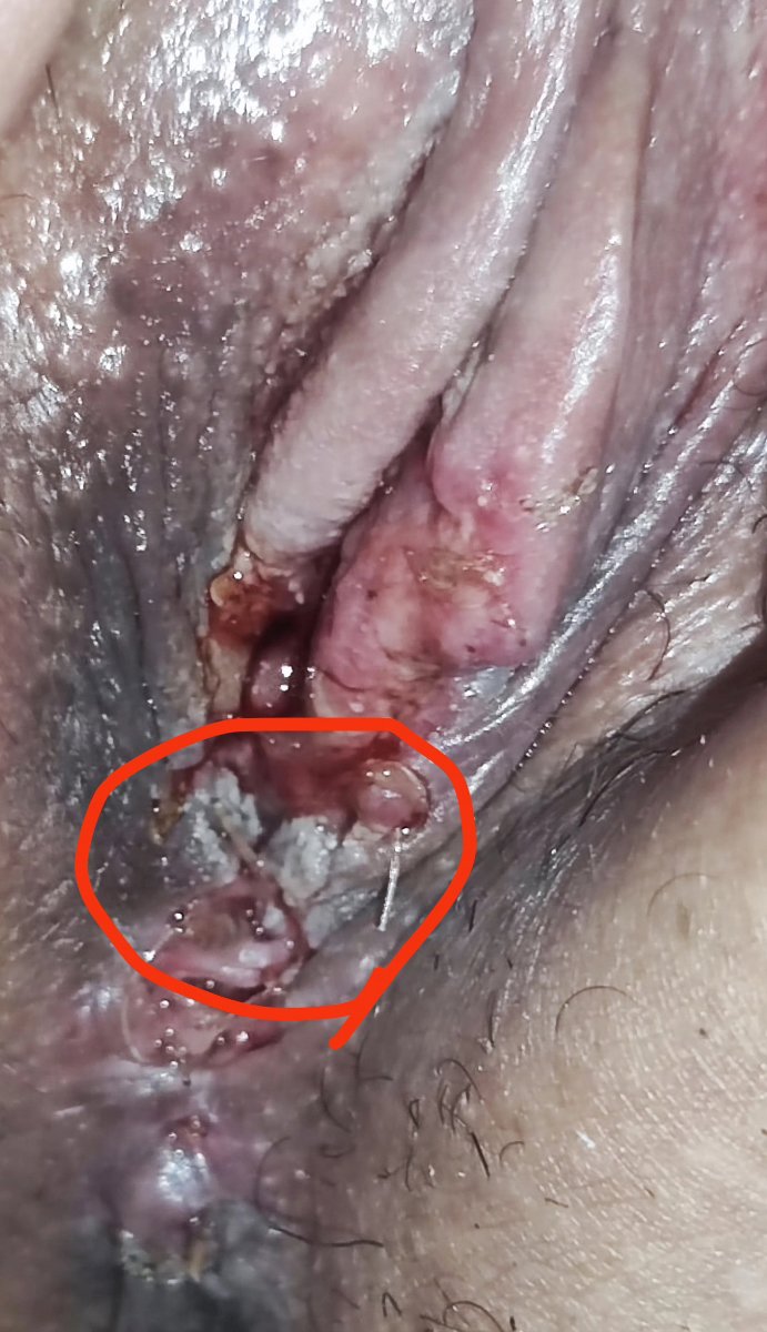 به نظرتون اینا عفونته به نظرتون اینا عفونته
