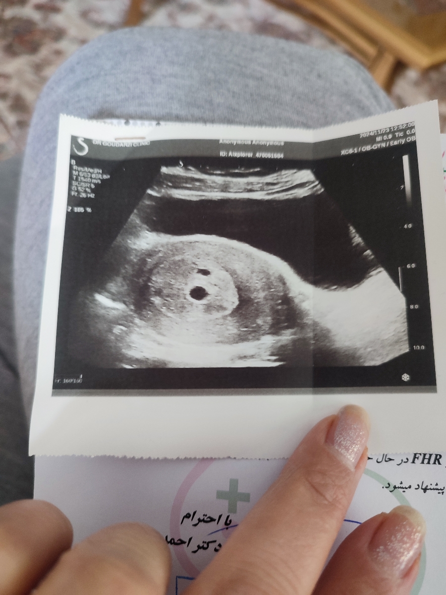 بارداری و دلایل تشکیل نشدن قلب و سقط جنین