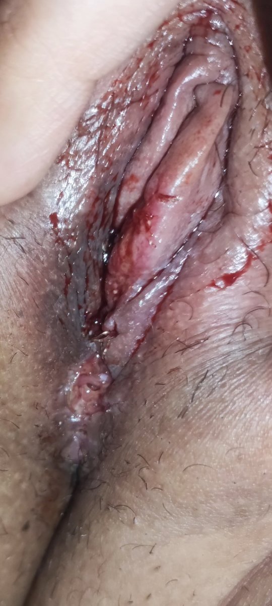 اینجوری هست یهویی خوابیده میزنم خون زیادی میاد اینجوری هست یهویی خوابیده میزنم خون زیادی میاد