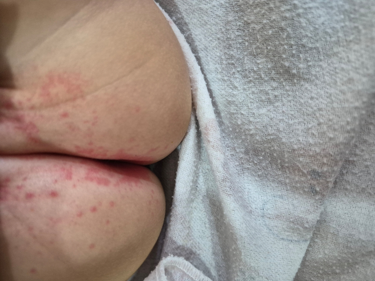 سوختگی پای شیرخوار یکساله