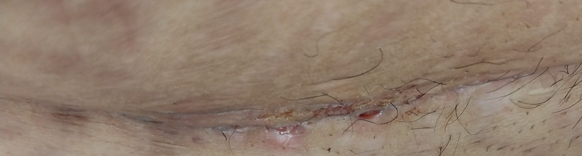 بخیه های سزارین ۷۰ روز بعد از زایمان ( عکس داره اگر بدتون میاد نیاین)