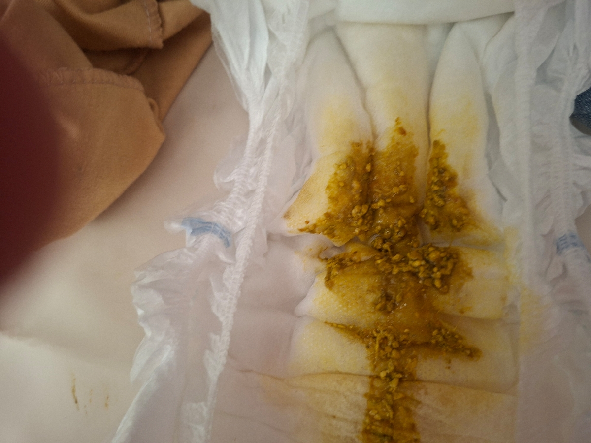 بابت ارسال عکس عذر میخوام شیر نان میخوره ولی خیلی شدید ولی به خودش میپیچه همیشه و شب ها سخت خواب میره به همش تکون میخوره تا زمانی تکون خوردنش تموم نشه خواب نمیره گاها یه مقدار کمی شیر بهش میدم بعدش راحت میخوابه یا پستونک بهش میدم ارومتر میشه ( از دل درد نیست آخه گریه نمیکنه ولی خیلی تکون میخوره و کش خواب میره ) بالا میاره البته زیاد نیست خودش قورتشون میده همیشه تو دهنش شیر هست ، بعد از شیر خوردن همیشه بالا میاره شیرش رو همراه آروغ زدنش همیشه پستونک میخوره وقتی هم پستونک نداشته باشه دهنش مثل آدامس خوردن تکون میده بابت ارسال عکس عذر میخوام شیر نان میخوره ولی خیلی شدید ولی به خودش میپیچه همیشه و شب ها سخت خواب میره به همش تکون میخوره تا زمانی تکون خوردنش تموم نشه خواب نمیره گاها یه مقدار کمی شیر بهش میدم بعدش راحت میخوابه یا پستونک بهش میدم ارومتر میشه ( از دل درد نیست آخه گریه نمیکنه ولی خیلی تکون میخوره و کش خواب میره ) بالا میاره البته زیاد نیست خودش قورتشون میده همیشه تو دهنش شیر هست ، بعد از شیر خوردن همیشه بالا میاره شیرش رو همراه آروغ زدنش همیشه پستونک میخوره وقتی هم پستونک نداشته باشه دهنش مثل آدامس خوردن تکون میده