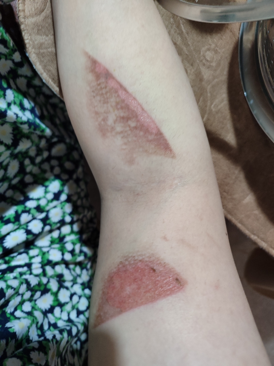 سوختگی دست عکس‌گذاشتم لطفا اگه دوست ندارین باز نکنید