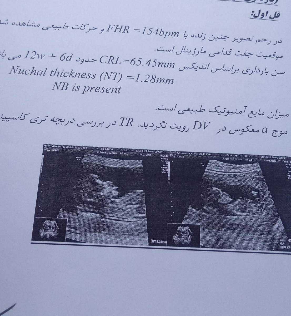 سونوگرافی انتی دوقلو لطفاً