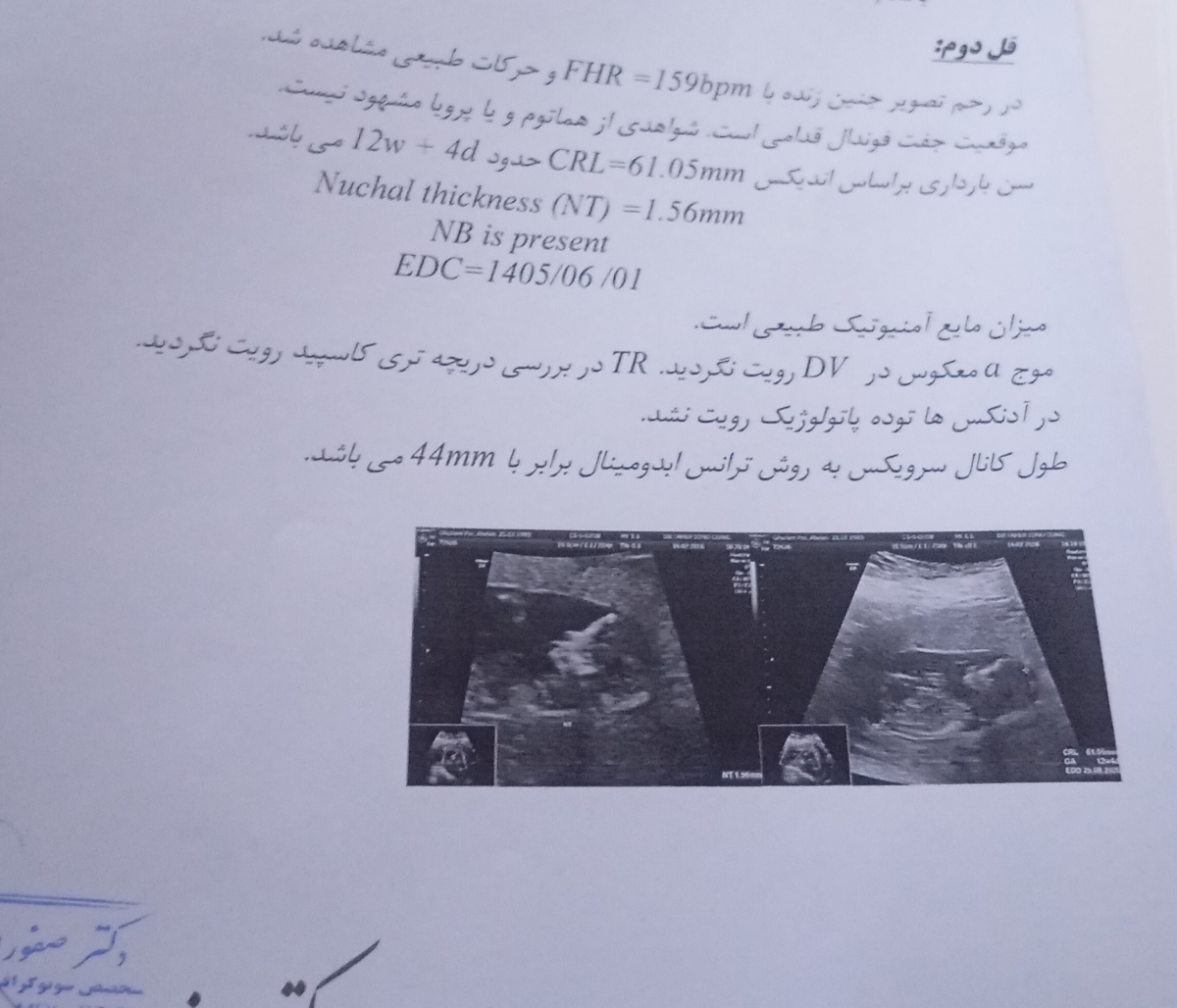 سونوگرافی انتی دوقلو لطفاً