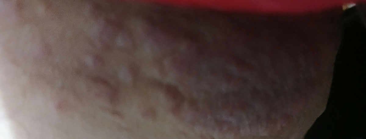 این جور دونه هایی زده و خارش زیاد میشه بگید چی هستن؟میترسم زگیل تناسلی باشه😭 این جور دونه هایی زده و خارش زیاد میشه بگید چی هستن؟میترسم زگیل تناسلی باشه😭