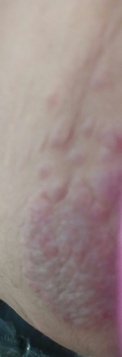 خارش و تاول های بزرگ کنار ناحیه تناسلی