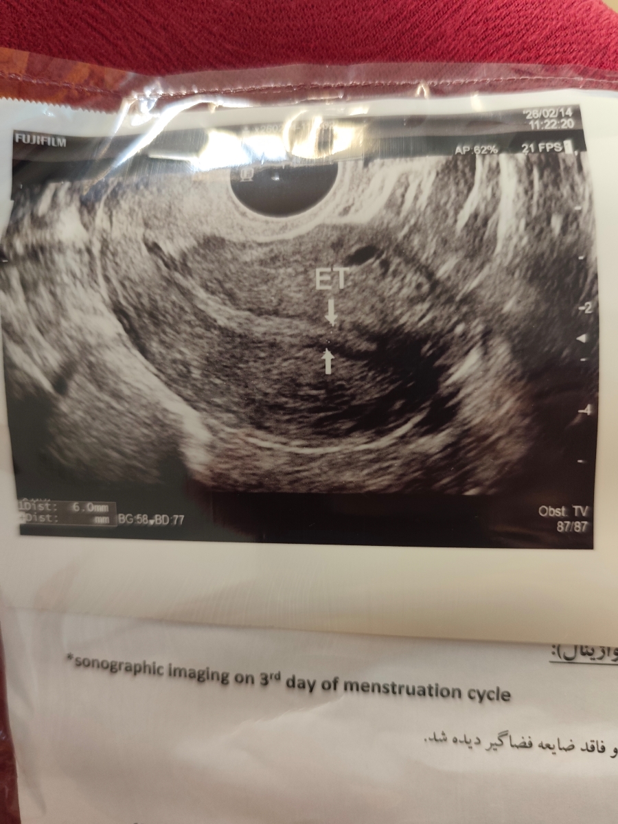 تاریخ دقیق پریود و تنبلی تخمدان