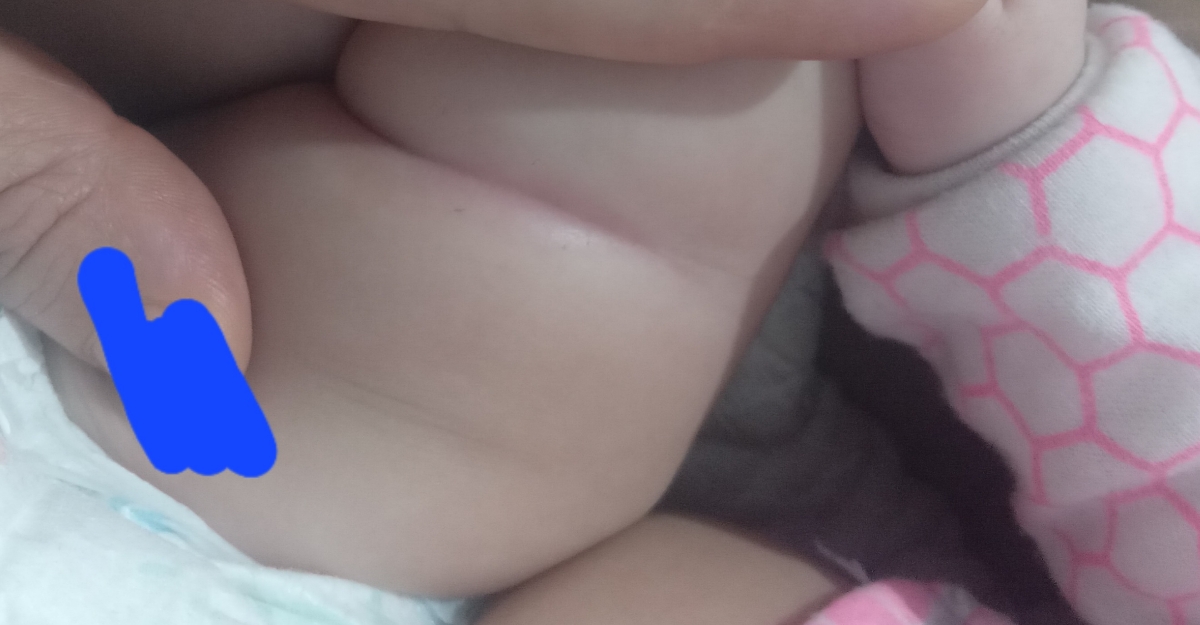 تپلی و چاقی و شیارهای روی پوست