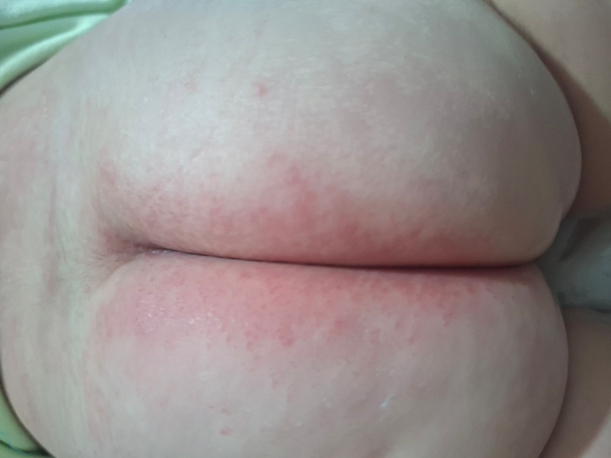 سوختگی و قرمزی باسن نوزاد