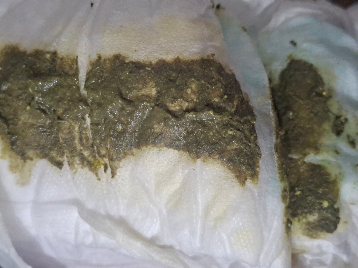 سوختگی و قرمزی باسن نوزاد