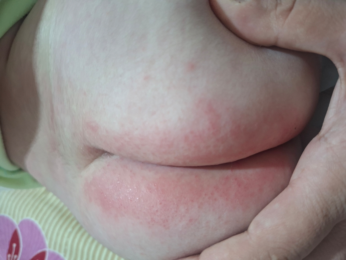 سوختگی و قرمزی باسن نوزاد