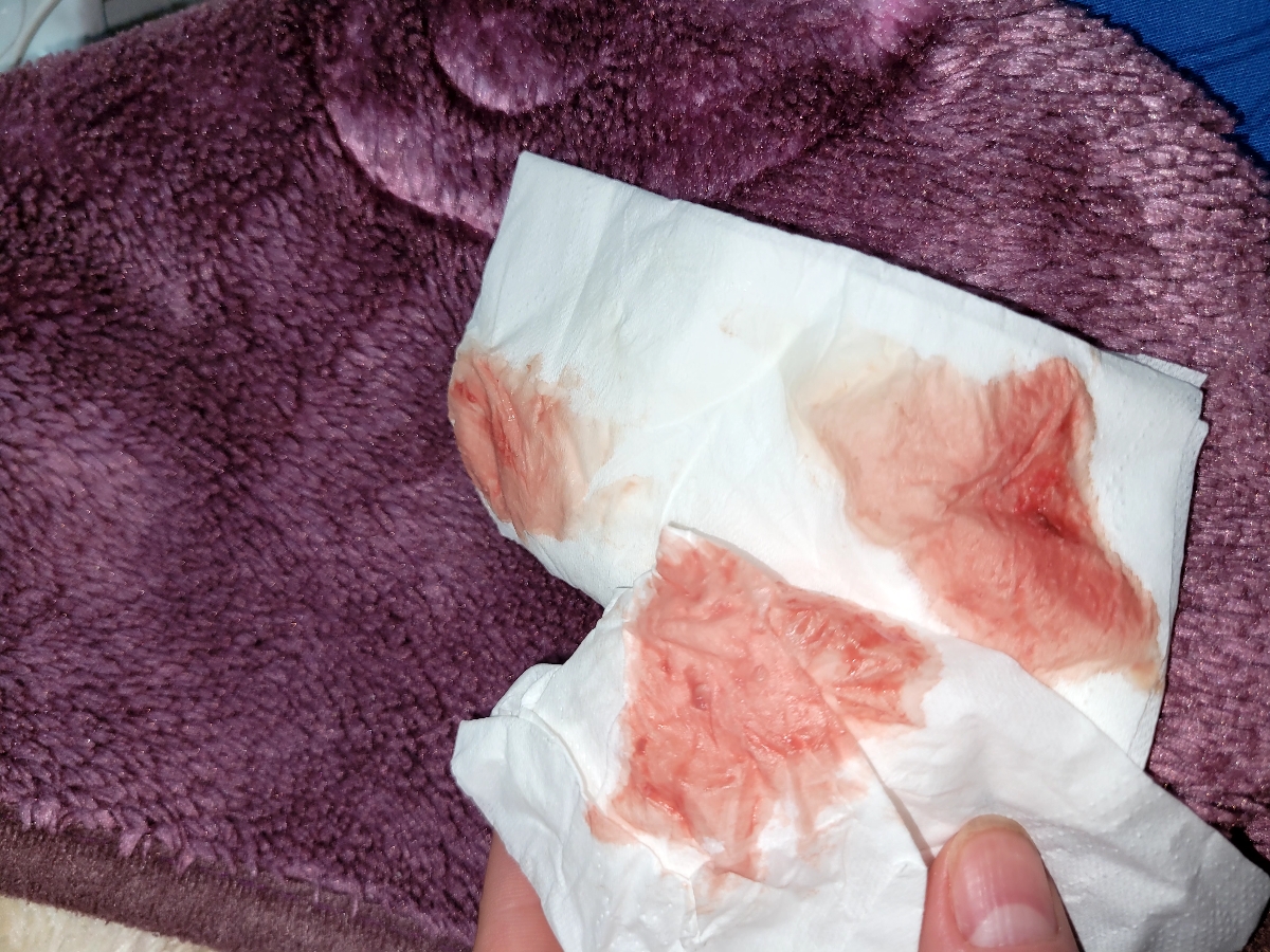 ببین این خون روز ۲۰ انتقال من بود فکر کنم چون دو روز قبلش بی بی زدم نوشته بودم روز ۱۸
با این خون بهم گفتن هماتوم هست