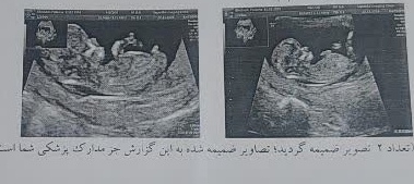 تعیین جنسیت جنین