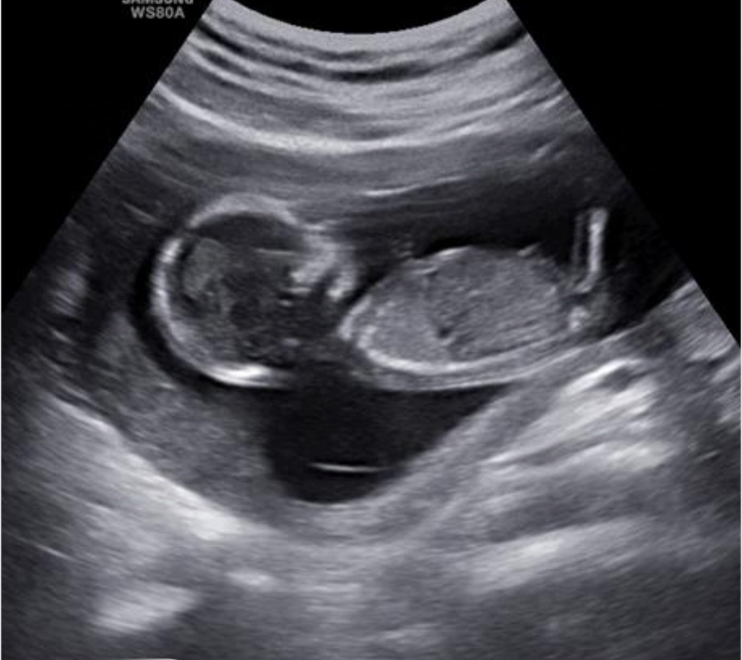 تفسیر آزمایش ان تی تفسیر آزمایش ان تی